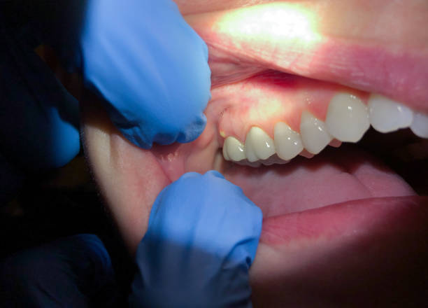 Best Emergency Treatment for Dental Infections or Abscesses in Wilkshire Hills, OH